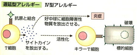 国家試験対策 型 型アレルギーの総まとめ テスト対策にも マロン